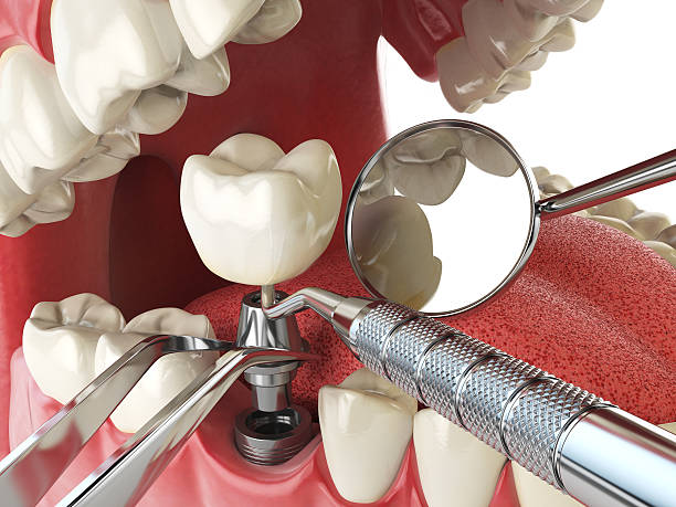 Best Emergency Treatment for Dental Infections or Abscesses in New Tazewell, TN